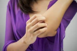 Neurodermitis mit Hilfe von Microsilber Creme behandeln